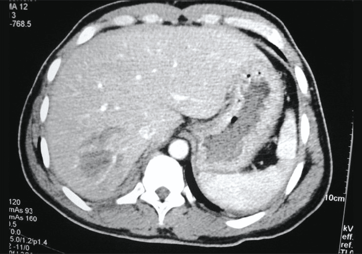 **Modality:** Axial contrast-enhanced computed tomography (CT) of the upper abdomen.

**Anatomical Region:** Liver and surrounding upper abdominal structures.

**Observed Pathology:** Grade II hepatic injury according to the AAST (American Association for the Surgery of Trauma) classification.

**Visual Features:**
- **Parenchymal Findings:** A localized, ill-defined hypodense area is visible within the posterior segment of the right hepatic lobe, consistent with an intraparenchymal hematoma or contusion.
- **Injury Characteristics:** The lesion measures less than 10 cm in diameter with no evidence of major vascular disruption or active extravasation of contrast material in this section.
- **Associated Findings:** A thin rim of hyperdense fluid is noted in the perihepatic and perisplenic spaces, suggestive of a small volume of hemoperitoneum. The spleen and visualized vasculature appear intact.

**Diagnostic Context:** Findings are characteristic of blunt abdominal trauma resulting in a stable hepatic parenchymal injury. The absence of deep lacerations (>3 cm) or expanding hematomas supports the Grade II classification, making this image a primary reference for non-operative trauma management indexing.