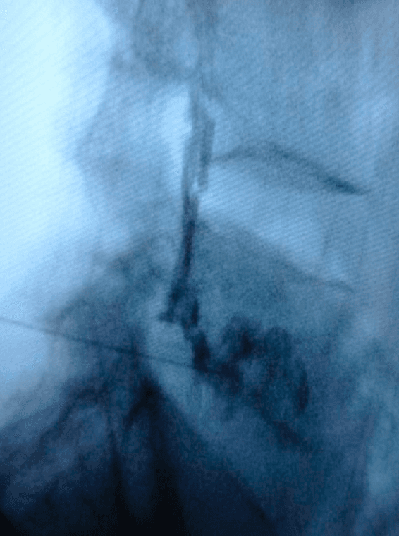 **Imaging Modality:** Fluoroscopy (Lateral projection)

**Anatomical Region:** Lumbar spine, specifically the lumbosacral junction.

**Procedure:** Transforaminal epidural injection/block.

**Observation and Key Features:**
The image displays a lateral fluoroscopic view of the lower lumbar vertebrae. A spinal needle is visualized with its tip positioned within the neural foramen. Radiopaque contrast medium has been injected, demonstrating a characteristic flow pattern. The contrast outlines the nerve root (radiculogram) and extends into the ventral epidural space, confirming intra-articular and epidural distribution. 

**Visual Characteristics:**
- **Needle Placement:** The needle trajectory is directed toward the upper posterior aspect of the neuroforamen ("safe triangle" zone).
- **Contrast Pattern:** Linear, vertical opacification consistent with epidural spread, alongside tracking along the exiting spinal nerve root.
- **Bony Landmarks:** The vertebral bodies, intervertebral disc spaces, and the sacral promontory are visible, though partially obscured by soft tissue density and contrast.

**Clinical Utility:**
This image serves as intraoperative documentation for a guided transforaminal block, utilized in the management of radiculopathy. The lateral view is essential to verify the needle depth and confirm that the contrast is spreading ventrally into the epidural space rather than posteriorly or intravascularly.