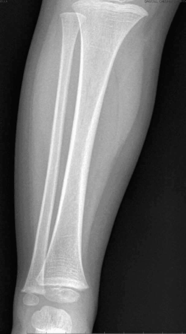 **Imaging Modality:** Projectional radiography (X-ray).

**Anatomical Region:** Anteroposterior (AP) view of the pediatric right lower leg, including the shafts of the tibia and fibula, the proximal metaphyses, and the distal epiphyses/physes near the ankle joint.

**Observed Pathology:** No acute osseous abnormalities are identified.

**Characteristic Visual Features:**
*   **Bone Morphology:** The cortical margins of the tibial and fibular diaphyses are smooth and continuous, with no evidence of fracture lines, cortical buckling, or periosteal reaction.
*   **Physeal Presentation:** The visible growth plates (physes) at the proximal and distal ends appear unremarkable for the patient's developmental age. 
*   **Joint Spaces:** The visible portions of the knee and ankle joints demonstrate maintained alignment and normal joint spacing.
*   **Soft Tissues:** The surrounding soft tissue planes are symmetric without focal swelling or radio-opaque foreign bodies.

**Key Diagnostic Features:** This radiograph represents a normal pediatric study of the tibia and fibula. The absence of a visible fracture line or subtle "toddler’s fracture" (undisplaced spiral fracture of the distal tibia) on this specific AP projection is noted.