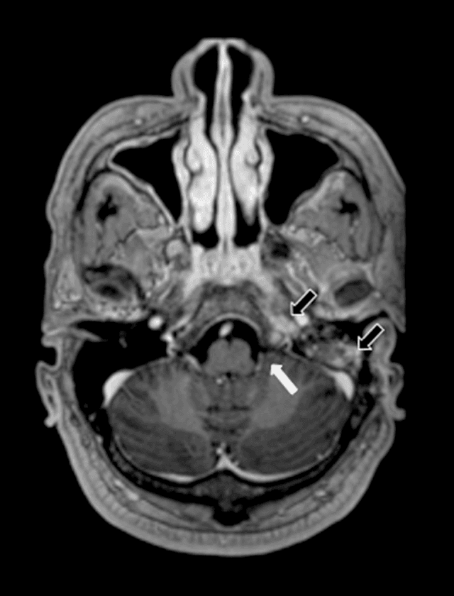 **Imaging Modality:** Magnetic Resonance Imaging (MRI), Axial plane.

**Sequence:** Post-contrast T1-weighted image.

**Anatomical Region:** Posterior fossa and skull base, specifically focusing on the left cerebellomedullary cistern (cisterna magna), petrous apex, and mastoid air cells.

**Observed Findings:**
*   **Cisterna Magna:** A white arrow indicates the left cerebellomedullary cistern. There is a notable absence of a peripherally enhancing collection, signifying the resolution of a previously documented abscess.
*   **Skull Base and Mastoid:** Black arrows highlight persistent, though reduced, contrast enhancement within the left petrous apex and the mastoid air cells. These features are consistent with improving petrositis and mastoiditis.
*   **Cranial Nerves:** Normalization of contrast uptake in the vicinity of the lower cranial nerves is observed compared to previous involvement.

**Diagnostic Context:** Post-treatment follow-up of a skull base infection (likely secondary to otomastoiditis) with secondary intracranial extension. The image demonstrates therapeutic response characterized by the resolution of a focal infectious collection (abscess) while showing residual inflammatory changes in the adjacent osseous structures.