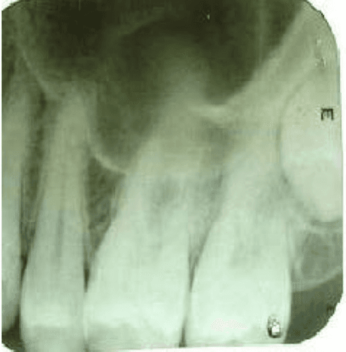 **Imaging Modality:** Intraoral periapical (IOPA) radiograph.

**Anatomical Region:** Maxillary anterior region, specifically focusing on the central and lateral incisors.

**Observed Pathology:** Large, well-defined, unilocular radiolucency with a thin, corticated border. The lesion is located periapically and appears to involve the roots of the maxillary incisors.

**Characteristic Visual Features:** 
- **Lesion:** A prominent, circular radiolucent area in the alveolar bone, suggestive of an odontogenic cyst or granuloma (e.g., radicular cyst). 
- **Dental Structures:** The adjacent teeth show signs of widened periodontal ligament spaces. There is evidence of potential root resorption or displacement of the involved teeth due to the expansive nature of the lesion.
- **Surrounding Bone:** The lesion exhibits a clear transition zone with a sclerotic/corticated rim, indicating a slow-growing, chronic process. The maxillary sinus floor or nasal fossa floor may be superiorly displaced.

**Key Diagnostic Features:** The well-circumscribed, corticated radiolucent appearance centered at the apex of a tooth is a hallmark of a periapical cyst. This image is critical for differentiating inflammatory periapical lesions from other odontogenic tumors.