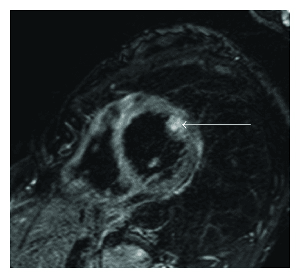 **Imaging Modality:** Cardiac Magnetic Resonance Imaging (MRI), T2-weighted sequence.

**Anatomical Region:** Heart, mid-ventricular short-axis view.

**Observed Pathology:** Eosinophilic myocarditis secondary to Churg-Strauss syndrome (Eosinophilic Granulomatosis with Polyangiitis). 

**Characteristic Visual Features:** The image demonstrates focal areas of increased signal intensity (hyperintensity) within the myocardium. A prominent, hyperintense patchy area is localized to the papillary muscle (indicated by the white arrow), consistent with localized myocardial edema. Additional subtle, patchy intramural T2 hyperintensities are visible within the left ventricular wall.

**Key Diagnostic Features:** T2-weighted hyperintensity is a primary radiologic marker for myocardial edema and active inflammation. In the clinical context of systemic vasculitis, this distribution pattern—specifically involving the papillary muscles and exhibiting a non-coronary, patchy distribution—is characteristic of eosinophilic infiltration and associated inflammatory response.

**Clinical Significance:** This finding is essential for diagnosing cardiac involvement in systemic hypereosinophilic syndromes and monitoring the inflammatory phase of myocarditis.