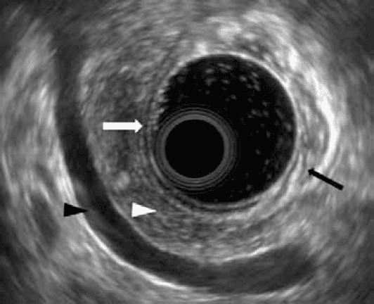 **Imaging Modality:** Electronic radial Endoscopic Ultrasound (EUS).

**Anatomical Region:** Upper gastrointestinal tract, specifically the stomach lumen and gastric wall, with visualization of the retroperitoneal space.

**Key Landmarks and Visual Features:**
*   **Gastric Wall:** The image demonstrates the characteristic five-layer sonographic architecture of the gastric wall. These layers include the hyperechoic superficial mucosa, hypoechoic deep mucosa (muscularis mucosae), hyperechoic submucosa, hypoechoic muscularis propria, and the outer hyperechoic serosa/adventitia.
*   **Gastric Folds:** Intraluminal protrusions of the gastric wall are visible, representing normal rugae.
*   **Extraluminal Structures:** Adjacent to the gastric wall, the pancreatic body is identified by its homogeneous, finely granular, salt-and-pepper echotexture. The splenic vein is visible as an anechoic, tubular vascular structure positioned posterior to the pancreas.

**Clinical Context/Pathology:** The image shows a normal physiological appearance of the gastric wall and surrounding pancreaticosplenic anatomy without evidence of wall thickening, masses, or lymphadenopathy.

**Diagnostic Features:** Preservation of the five-layer wall stratification is a key diagnostic indicator used to exclude transmural infiltration by malignancy or deep inflammatory processes.