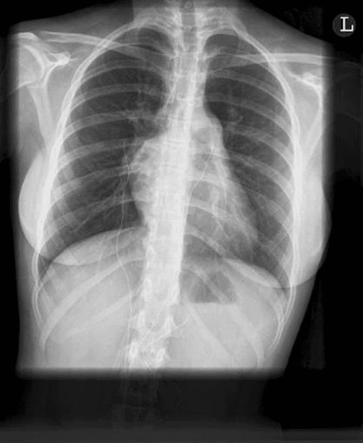 **Modality:** Posteroanterior (PA) Chest Radiograph (X-ray).

**Anatomical Region:** Thorax, including the lungs, mediastinum, and cardiac silhouette.

**Observed Pathology:** Findings are highly suggestive of pulmonary arterial hypertension (PAH) with associated cor pulmonale.

**Characteristic Visual Features:**
*   **Cardiovascular:** Marked prominence of the main pulmonary artery segment (pulmonary trunk). Significant enlargement of the right heart borders, consistent with right atrial and right ventricular hypertrophy/dilation. The cardiac silhouette is widened with a shifted apex.
*   **Pulmonary Vasculature:** Demonstrable "pruning" effect, characterized by dilated central hilar pulmonary arteries followed by rapid tapering and rarification (oligaemia) of the peripheral pulmonary vessels. 
*   **Lung Parenchyma:** Clear lung fields without focal consolidation, pleural effusion, or overt pulmonary edema.

**Diagnostic Features:** The constellation of central pulmonary artery dilation alongside peripheral vascular pruning and right-sided cardiomegaly serves as a classic radiographic indicator of elevated pulmonary vascular resistance and secondary right heart strain.

**Clinical Context:** Consistent with chronic pulmonary arterial hypertension.