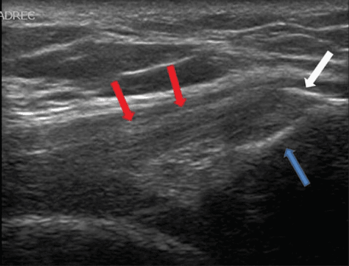 **Imaging Modality:** Ultrasound (Grey-scale, longitudinal view)

**Anatomical Region:** Anterior knee, specifically the quadriceps tendon and the superior pole of the patella.

**Observed Pathology:** Calcific tendinopathy of the distal quadriceps tendon.

**Characteristic Visual Features:**
*   **Quadriceps Tendon:** The image displays a thickened quadriceps tendon with a loss of the normal organized fibrillar pattern, appearing heterogeneously hypoechoic.
*   **Calcification:** A focal, linear hyperechoic focus is visible at the distal aspect of the tendon near its insertion site.
*   **Bony Landmark:** The superior cortex of the patella is visualized, showing a distinct interface with the tendon insertion.
*   **Annotated Features:** Red arrows delineate the body of the quadriceps tendon; the blue arrow indicates the patellar insertion site; the white arrow highlights the intratendinous calcification.

**Diagnostic Differentiating Features:** The presence of focal hyperechoic material within a thickened, hypoechoic tendon at the insertion site is highly characteristic of calcific insertional tendinopathy, distinguishing it from simple tendinosis or an acute partial tear.
