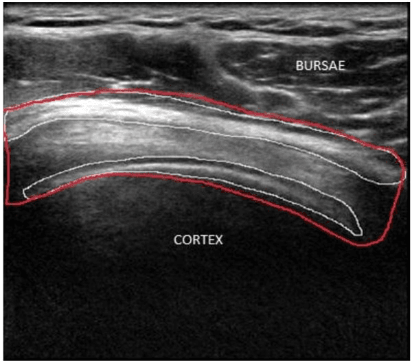 **Imaging Modality:** Musculoskeletal Ultrasound (B-mode).

**Anatomical Region:** Shoulder joint, specifically focusing on the subacromial-subdeltoid region and the underlying humeral head.

**Key Landmarks and Observed Structures:**
- **Bursae:** The subacromial-subdeltoid bursa is visible as a hypoechoic plane superior to the rotator cuff tendons.
- **Cortex:** The hyperechoic, curvilinear bony cortex of the humeral head is visible at the inferior aspect of the image, characterized by strong acoustic shadowing deep to the interface.
- **Rotator Cuff:** The supraspinatus tendon is positioned between the bursa and the bony cortex, exhibiting a fibrillar echotexture.

**Image Annotations:**
- **Manual Segmentation:** Red and white contour lines delineate the boundaries of the anatomical layers. 
- **Labels:** Text overlays identify the "BURSAE" (superiorly) and "CORTEX" (inferiorly).

**Diagnostic/Visual Features:** 
The image demonstrates standard anatomical relationships used in the assessment of subacromial impingement or tendinopathy. The clear differentiation between the superficial deltoid muscle, the intermediate bursa/tendon complex, and the deep bony cortex provides a baseline for evaluating inflammatory changes or structural tears.