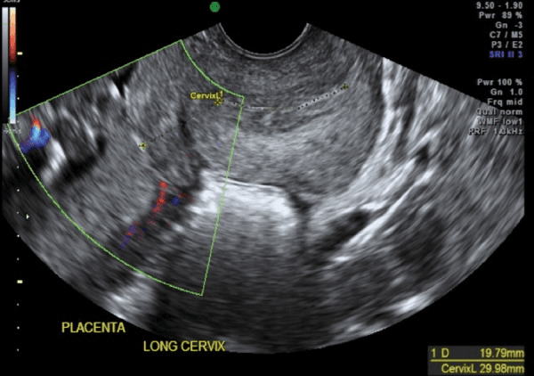 **Imaging Modality:** Transvaginal Ultrasound (TVUS) with Color Doppler.

**Anatomical Region:** Lower uterine segment, cervix, and posterior placenta.

**Visual Features:**
- **Cervix:** The endocervical canal is clearly delineated and measured (CervixL 29.98 mm), appearing elongated and closed.
- **Myometrium:** There is a focal, hypoechoic thickening of the lower uterine segment adjacent to the internal os, consistent with a localized myometrial contraction (Braxton Hicks).
- **Placenta:** A posterior placenta is visible, positioned superior to the cervical os.
- **Doppler Findings:** Limited color flow mapping is visible in the periphery, likely representing maternal vasculature.

**Diagnostic Considerations:**
The image illustrates a dynamic lower uterine segment contraction. Such contractions can transiently thicken the myometrium and shift the apparent position of the placental edge or internal os. This physiological finding is a known pitfall in obstetric imaging that can mimic the appearance of a short cervix or placenta previa. Distinguishing the homogeneous, transient nature of the contraction from the granular texture of the placenta is critical for accurate diagnosis.
