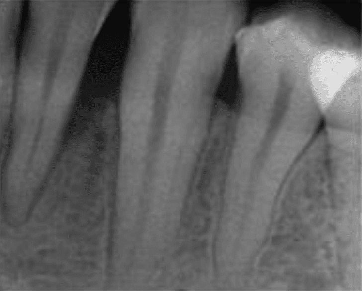 **Imaging Modality:** Intraoral periapical radiograph.

**Anatomical Region:** Mandibular posterior segment, involving multiple permanent teeth and their associated supporting structures.

**Observed Pathology:** The radiograph demonstrates significant generalized horizontal bone loss. There is a prominent vertical (angular) bony defect distal to the second premolar/mesial to the molar. A radiopaque restorative material is visible on the distal-occlusal aspect of the crown of the most posterior tooth shown.

**Characteristic Visual Features:**
*   **Alveolar Bone:** Reduction in the height of the alveolar crest relative to the cementoenamel junction (CEJ), indicating periodontitis. 
*   **Periodontal Ligament (PDL) Space:** Widening of the PDL space is visible along the root surfaces of the affected teeth.
*   **Trabecular Pattern:** Normal to slightly decreased radiodensity of the interdental bone, consistent with inflammatory bone resorption.
*   **Root Anatomy:** The roots appear intact without evidence of external resorption; however, the lack of bone support is evident in the cervical and middle thirds of the roots.

**Diagnostic Features:** Horizontal and vertical bone resorption patterns characteristic of chronic periodontal disease. The image captures the baseline state of periodontal destruction prior to therapeutic intervention.