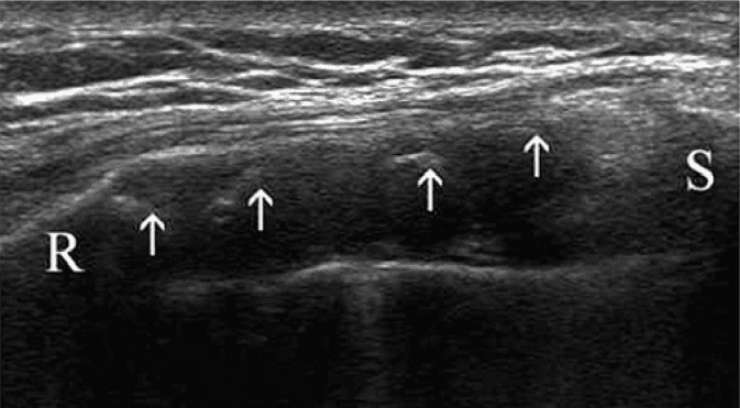 **Imaging Modality:** Greyscale Ultrasound (high-frequency linear transducer).

**Anatomical Region:** Anterior chest wall at the costochondral junction. Key landmarks include the osseous rib (labeled 'R'), the sternum (labeled 'S'), and the intervening costal cartilage.

**Observed Pathology:** Costal cartilage calcification.

**Characteristic Visual Features:** The image displays a longitudinal view of the costal cartilage, which appears as a relatively hypoechoic, elongated structure. Within the cartilaginous matrix, multiple discrete, hyperechoic (bright) foci are visible (indicated by white arrows). These hyperechoic clusters represent areas of mineralization or calcification. The underlying cortical surfaces of the rib and sternum exhibit characteristic hyperechoic lines with distal acoustic shadowing.

**Diagnostic Features:** The presence of scattered internal echogenicities within the normally hypoechoic costal cartilage is diagnostic of cartilaginous calcification. This finding is often associated with physiological aging or specific inflammatory conditions of the chest wall, such as costochondritis. The distribution is localized between the bony landmarks of the thoracic cage.