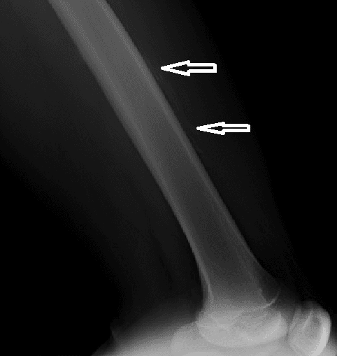 **Imaging Modality:** Conventional radiography (X-ray)

**Anatomical Region:** Left femur, lateral (profile) view, including the mid-diaphysis and distal metaphysis.

**Observed Pathology:** Multilamellar periosteal reaction (also known as "onion-skin" appearance) located along the mid-diaphyseal cortical surface.

**Characteristic Visual Features:**
*   **Periosteal Apposition:** Linear, layered radiodense streaks parallel to the long axis of the femoral shaft, indicated by white arrows.
*   **Cortical Integrity:** The underlying cortex appears thickened but lacks overt evidence of gross destruction or aggressive osteolysis in the visualized segment.
*   **Soft Tissue:** Subtle increased radiopacity in the adjacent soft tissues, suggesting swelling or hematoma formation.

**Clinical Context & Differentiation:** This aggressive-appearing periosteal reaction is consistent with a subperiosteal hematoma (often associated with hemophilia pseudotumor) or can mimic primary bone malignancies such as Ewing sarcoma. The distribution is localized to the mid-shaft of the long bone.

**Key Diagnostic Features:** Multi-layered periosteal thickening; absence of Codman’s triangle or sunburst pattern; localized to the diaphysis of the femur.