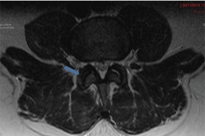 **Imaging Modality:** Magnetic Resonance Imaging (MRI), axial cross-section.

**Anatomical Region:** Lumbar spine at the level of the posterior elements and facet joints.

**Observed Findings:** The image displays the bilateral lumbar zygapophyseal (facet) joints. A blue arrow indicates the right-sided facet joint. There is an absence of significant joint effusion, synovial thickening, or surrounding soft-tissue edema. The articular surfaces appear regular with preserved joint space. No marrow edema is visualized in the adjacent pedicles or lamina, and the surrounding paraspinal musculature maintains normal signal intensity.

**Clinical Context/Differentiating Features:** This follow-up scan demonstrates the resolution of inflammatory or infectious changes (septic arthritis). The lack of hyperintense signal on this T2-weighted or STIR-type sequence indicates a decrease in active inflammation and successful response to treatment. The spinal canal and neural foramina appear patent without evidence of compressive collections or epidural extension.