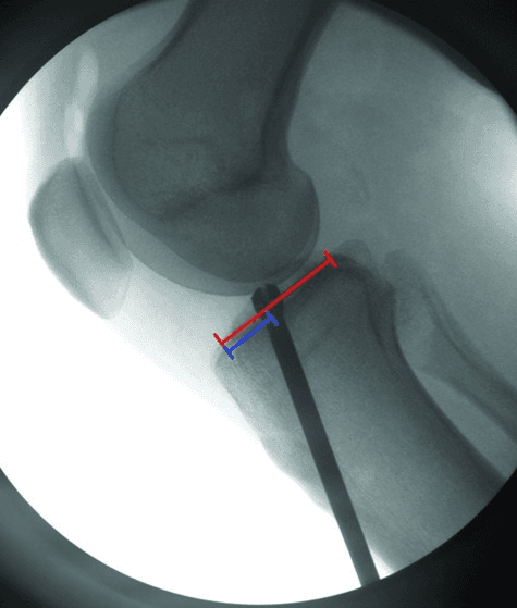 **Imaging Modality:** Intra-operative fluoroscopy.

**Anatomical Region:** Lateral view of the knee joint, including the distal femur, proximal tibia, and patella.

**Procedure & Context:** Anterior Cruciate Ligament (ACL) reconstruction. The image captures the intra-operative phase of tibial tunnel preparation.

**Key Landmarks & Observations:**
- **Skeletal structures:** The femoral condyles and tibial plateau are visible in a lateral profile.
- **Surgical Instrumentation:** A radiopaque rigid reamer or guide pin is positioned within the proximal tibia, oriented toward the anatomical footprint of the ACL on the tibial plateau.
- **Quantitative Overlays:** Red and blue measurement calipers are superimposed on the tibial plateau to assess the sagittal positioning and diameter of the tibial tunnel or the trajectory of the hardware relative to the posterior cruciate ligament (PCL) and anterior tibial cortex.
- **Hardware Alignment:** The image evaluates the posterior-to-anterior positioning of the reamer/tunnel to ensure anatomical graft placement and avoid impingement.

**Clinical Significance:** This fluoroscopic view is critical for confirming the precise entry point and trajectory of the tibial tunnel during ligament reconstruction to prevent graft failure or knee instability.