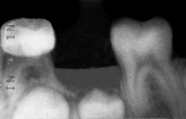 **Imaging Modality:** Intraoral periapical radiograph.

**Anatomical Region:** Posterior mandible demonstrating primary and permanent dentition in a pediatric or mixed-dentition patient.

**Observed Pathology/Procedures:** 
The radiograph shows a postoperative site following the extraction of a primary molar (likely the mandibular second primary molar). A radiopaque orthodontic band is visible on the adjacent primary tooth to the left, which is part of a distal shoe space maintainer. The horizontal extension or "blade" of the space maintainer is visible, extending into the soft tissue and alveolar bone of the extraction socket to guide the eruption of the unerupted permanent first molar.

**Characteristic Visual Features:**
*   **Space Maintainer:** A distal shoe appliance with a radiopaque band and a subgingival extension.
*   **Erupting Permanent Dentition:** The crown of the permanent first molar is visible positioned distally to the extraction site, while the developing permanent premolar buds are visible inferior to the primary tooth roots.
*   **Bone Healing:** The extraction socket shows early signs of healing with a reduction in radiolucency and initial bone remodeling.

**Diagnostic Features:** Proper positioning of the distal shoe guide plane relative to the mesial surface of the unerupted permanent molar crown.