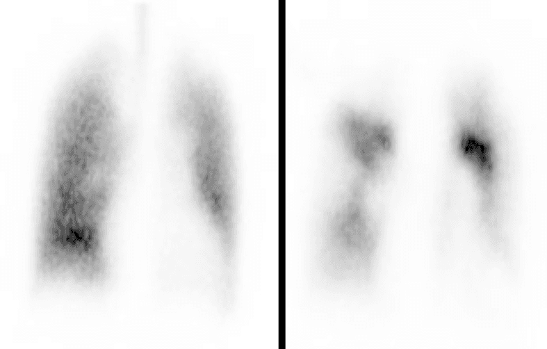 **Imaging Modality:** Lung Scintigraphy (V/Q Scan)

**Anatomical Region:** Bilateral lungs, thoracic cavity.

**Observed Pathology:** The image demonstrates a classic ventilation-perfusion (V/Q) mismatch. The perfusion scan (right panel) reveals multiple large, wedge-shaped, segmental photopenic areas indicating significant perfusion defects throughout both lung fields. Conversely, the ventilation scan (left panel) shows relatively homogeneous tracer distribution without corresponding filling defects.

**Characteristic Visual Features:**
*   **Perfusion Scan:** Multi-focal areas of absent or diminished radiopharmaceutical uptake, particularly noted in the middle and lower zones of the right lung and the mid-zone of the left lung.
*   **Ventilation Scan:** Preserved ventilation across both lung fields, contrasting with the perfusion irregularities.
*   **Pattern:** Non-matched defects, where ventilation is normal in areas of absent perfusion.

**Clinical Context and Diagnostic Features:** This V/Q mismatch pattern is highly suggestive of pulmonary embolism (PE). The presence of multiple segmental perfusion defects in the setting of normal ventilation is the primary diagnostic criterion for a "high probability" lung scan for thromboembolic disease. These findings allow for the differentiation from obstructive lung diseases, which typically present with matched V/Q defects.