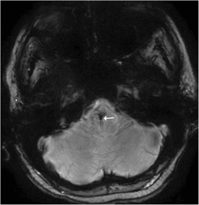 **Imaging Modality:** Magnetic Resonance Imaging (MRI), Susceptibility-Weighted Imaging (SWI).

**Anatomical Region:** Axial section of the posterior fossa, specifically localized to the pontomedullary junction of the brainstem.

**Observed Pathology:** Capillary telangiectasia.

**Characteristic Visual Features:** The image demonstrates a focal area of signal loss (hypointensity) within the brainstem parenchyma, indicated by a white arrow. This "blooming" effect is characteristic of paramagnetic substances, such as deoxyhemoglobin or hemosiderin, within slow-flow vascular channels. The lesion exhibits a subtle, radiating "caput medusa" morphology, characterized by fine, brush-like peripheral vessels converging toward a central point. There is no evidence of surrounding edema or mass effect on the adjacent cerebellar hemispheres or fourth ventricle.

**Key Diagnostic Features:** The marked hypointensity on susceptibility-weighted sequences in an asymptomatic location is highly suggestive of a capillary telangiectasia. The lack of signal void on T1 or T2 sequences (not shown) and the presence of fine radiating vasculature help differentiate this from other vascular malformations like cavernous malformations or developmental venous anomalies (DVA).