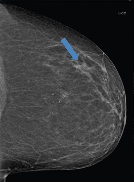 **Imaging Modality:** Diagnostic mammography.

**Anatomical Region:** Left breast, Craniocaudal (L-CC) view.

**Observed Pathology:** Duct ectasia/dilated mammary ducts.

**Characteristic Visual Features:** The image displays a focal area of prominent, branching tubular radiodensities located within the outer hemisphere of the breast parenchyma. These structures originate from the retroareolar region and extend peripherally, consistent with dilated lactiferous ducts. A blue arrow highlights the primary site of these tubular densities. The surrounding breast tissue appears predominantly fatty-replaced with scattered fibroglandular densities (BI-RADS Breast Composition Category B). No suspicious microcalcifications, speculated masses, or significant architectural distortion are visualized in the immediate vicinity of the dilated ducts.

**Key Diagnostic Features:** Branching tubular patterns in a ductal distribution, absence of associated solid mass or suspicious pleomorphic calcifications, and localized manifestation in the outer quadrant. These findings are characteristic of benign ductal dilatation or ectasia.