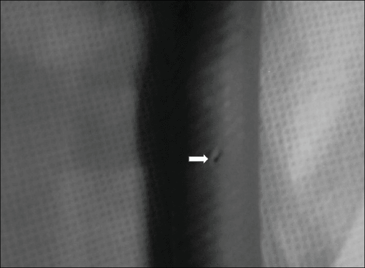 **Imaging Modality:** Clinical photograph (close-up)

**Anatomical/Equipment Region:** Medical gas delivery system; specifically, a nitrous oxide pipeline/hose.

**Observed Pathology/Abnormality:** Structural failure of a high-pressure medical gas pipeline characterized by localized dilation (aneurysmal bulging) and a discrete perforation.

**Characteristic Visual Features:**
*   **Dilation:** The image shows a segment of a dark, flexible pipeline with a visible focal expansion or bulging, indicating a loss of structural integrity of the wall.
*   **Perforation:** A white arrow points directly to a small, longitudinal slit-like hole or rupture located within the center of the dilated area.
*   **Surface Texture:** The pipeline exhibits a cross-hatched or braided reinforced texture typical of medical-grade high-pressure hoses.

**Clinical Context:** This represents a critical equipment failure in an anesthesia or perioperative setting. Such defects in a nitrous oxide pipeline can lead to gas leaks, loss of delivery pressure, and potential environmental exposure to anesthetic gases.

**Key Diagnostic Features:** Focal wall thinning and rupture in a pressurized conduit, distinguished by the physical deformation (bulge) preceding the breach.
