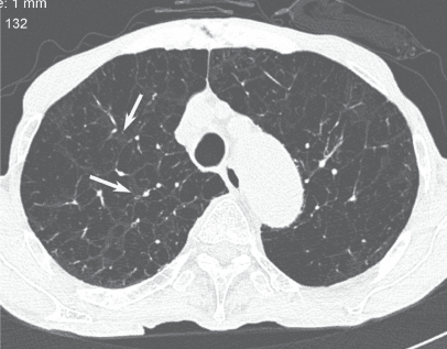 **Imaging Modality:** High-resolution computed tomography (HRCT), axial section.

**Anatomical Region:** Thorax, specifically the upper lobes of the lungs.

**Observed Pathology:** Advanced centriacinar (centrilobular) emphysema.

**Characteristic Visual Features:** The image demonstrates diffuse, bilateral areas of low attenuation representing parenchymal destruction and airspace enlargement. These lucencies lack discernible walls, distinguishing them from cystic lung disease. While the disease is extensive, there are focal areas of preserved, higher-attenuation lung parenchyma immediately adjacent to the central bronchovascular bundles (indicated by arrows). This "sparing" of the immediate perilobular area suggests a centrilobular origin of the destructive process. The pulmonary vasculature appears attenuated and distorted within the areas of emphysematous change.

**Key Diagnostic Features:** The presence of small, discrete lucencies centered on the core of the secondary pulmonary lobule is characteristic of centriacinar emphysema. In this advanced stage, the coalescence of these lucencies mimics panacinar emphysema; however, the identification of residual normal lung tissue surrounding the central bronchovascular structures serves as a critical differentiating feature for centriacinar classification.
