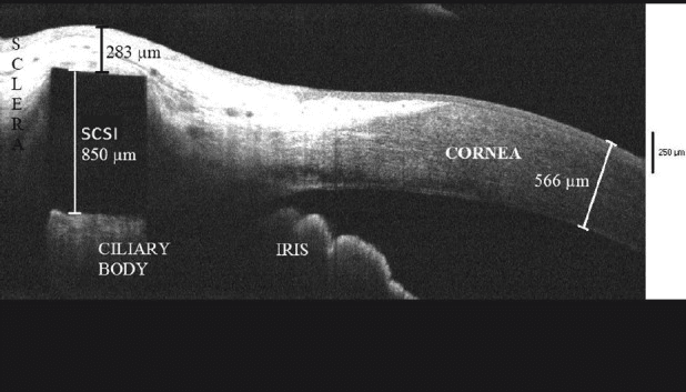 **Modality:** Anterior segment optical coherence tomography (AS-OCT).

**Anatomical Region:** Anterior segment of the eye, specifically the corneoscleral junction (limbus), ciliary body, and iris.

**Observed Findings:**
The image displays a cross-sectional view of a supraciliary contraction segment implant (SCSI) positioned within the supraciliary space. The SCSI is visualized as a highly reflective, rectangular signal-void shadow measuring 850 µm in height. It is situated deep to the sclera and superficial to the ciliary body. 

**Characteristic Visual Features:**
- **Scleral Thinning/Proximity:** The distance between the anterior edge of the SCSI and the external scleral surface is measured at 283 µm, indicating a superficial migration or shallow placement of the device.
- **Corneal Morphometry:** Central/peripheral corneal thickness is annotated at 566 µm.
- **Structural Displacement:** There is a visible anterior elevation of the overlying scleral tissue corresponding to the location of the implant.

**Clinical Context:**
This AS-OCT image assesses the anatomical positioning and potential migration of supraciliary implants used in the surgical treatment of presbyopia. The primary finding is the thinning of the overlying scleral cover, which may precede device exposure or extrusion.