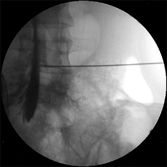 **Imaging Modality:** Intra-operative fluoroscopy (spot film).

**Anatomical Region:** Lateral view of the lumbar spine, specifically focusing on the lower lumbar vertebrae and the sacral promontory.

**Procedure and Findings:** 
The image demonstrates a fluoroscopically guided needle placement for a spinal procedure. A radiopaque spinal needle is visible, transversing the soft tissues and terminating within the spinal canal. Intrathecal administration of water-soluble contrast media is evidenced by a distinct, vertical column of radiopacity flowing within the subarachnoid space (myelographic effect). The contrast is seen layering anteriorly and inferiorly along the spinal canal, highlighting the borders of the dural sac.

**Key Visual Features:**
- **Needle Position:** Lateral approach with the tip localized to the posterior aspect of the vertebral canal.
- **Contrast Pattern:** Sharp, linear opacification characteristic of intrathecal (subarachnoid) distribution, rather than the "feathery" or "vacuolated" appearance typical of epidural injection.
- **Landmarks:** Lumbar vertebral bodies, intervertebral disc spaces, and the spinous processes are partially visualized.

**Clinical Significance:** This image serves as confirmation of needle tip positioning within the intrathecal space during a myelogram, lumbar puncture, or spinal anesthesia procedure.