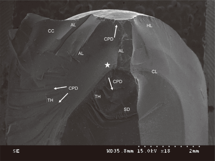 **Imaging Modality:** Scanning Electron Microscopy (SEM) fractography image.

**Anatomical Region/Subject:** Fracture surface of a dental crown (CAD/CAM lithium disilicate or similar ceramic) with a 1.5 mm occlusal thickness, mounted on a supporting die (SD) with an interfacial cementation layer (CL).

**Observed Pathology/Findings:** The image displays a detailed topographical analysis of a structural failure. The origin of the fracture (marked with a white star) is centrally located. Crack propagation directions (CPD) radiate outward from this origin toward the occlusal and cervical margins.

**Characteristic Visual Features:**
*   **Hackles:** Hackle lines (HL) and twist hackles (TH) are visible, indicating rapid crack growth and stress orientation changes.
*   **Arrest Lines (AL):** Discernible markings indicating temporary pauses in crack front progression.
*   **Compression Curl (CC):** Located at the terminal edge of the fracture, representing the final stage of failure under compressive stress.
*   **Interface:** The transition between the ceramic crown material, the thin cementation layer (CL), and the underlying supporting die (SD) is visible at the lower margins.

**Diagnostic Significance:** These fractographic features are characteristic of brittle material failure, used to determine the initiation point and energy dynamics of dental restorative fractures.