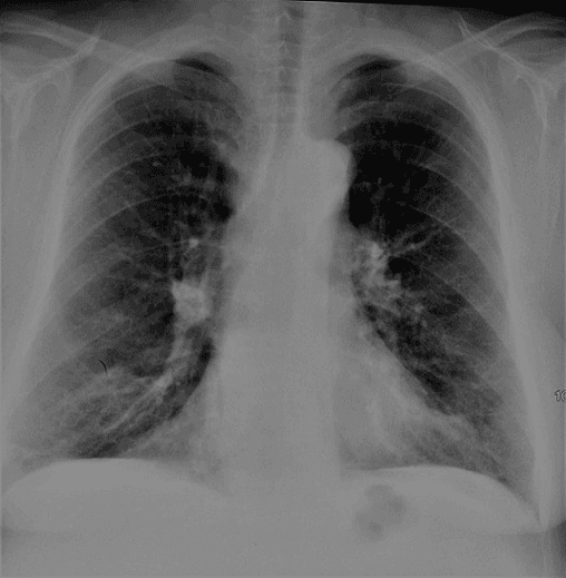 **Imaging Modality:** Posteroanterior (PA) chest X-ray.

**Anatomical Region:** Thoracic cage, including lungs, mediastinum, and diaphragm.

**Observed Pathology and Visual Features:**
The radiograph demonstrates significant signs of pulmonary hyperinflation (thoracic distension). Key findings include:
*   **Diaphragmatic Flattening:** Bilateral depression and flattening of the hemidiaphragms, indicating increased lung volume.
*   **Increased Lucency:** Diffuse increase in lung radiolucency, consistent with air trapping.
*   **Bronchial Changes:** Visible peribronchial cuffing and thickening of the bronchial walls, particularly evident in the perihilar regions.
*   **Rib Configuration:** Horizontalization of the ribs and widening of the intercostal spaces.
*   **Mediastinal Profile:** A narrow, "vertical" heart configuration (drop heart) often associated with chronic obstructive pulmonary disease (COPD).

**Clinical Context:**
The combination of hyperinflation and bronchial wall thickening is highly characteristic of chronic obstructive airway disease, such as COPD or chronic bronchitis.

**Key Diagnostic Features:**
The presence of flattened diaphragms and peribronchial thickening serve as the primary visual cues for distinguishing obstructive lung pathology from restrictive patterns or acute consolidations. No acute pleural effusions or focal masses are identified.