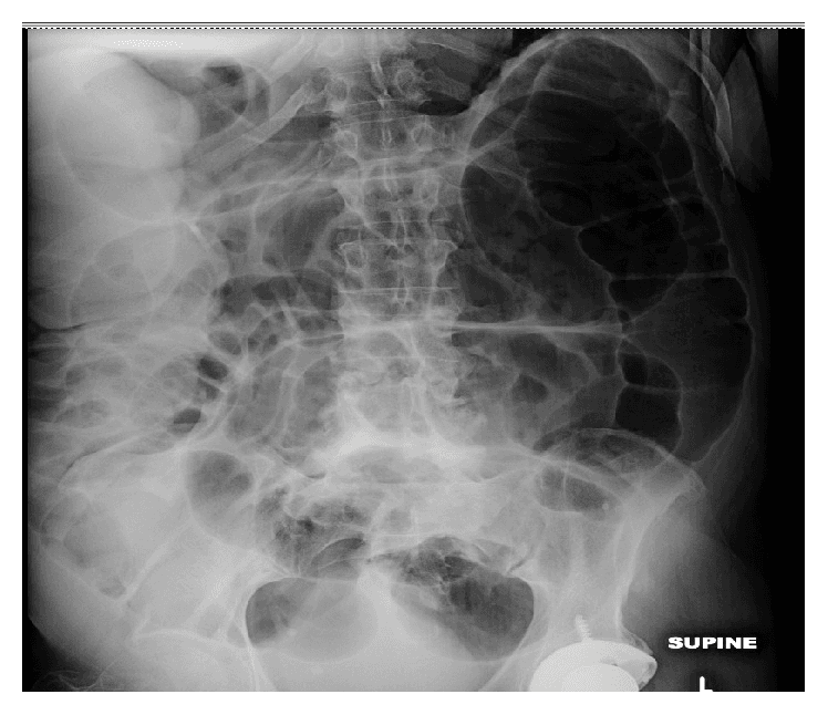 **Imaging Modality:** Abdominal X-ray (Supine view)

**Anatomical Region:** Abdomen and pelvis

**Observed Pathology:** Massive, generalized colonic dilatation consistent with Acute Colonic Pseudo-obstruction (Ogilvie’s Syndrome).

**Characteristic Visual Features:**
The radiograph demonstrates profound gaseous distension of the large bowel, most prominent in the cecum, ascending colon, and transverse colon. The haustral markings remain visible despite the severe mural stretching, a feature that helps distinguish colonic from small bowel dilatation. There is a lack of evidence of mechanical transition points or distal gas depletion, with air visualized throughout the rectum and sigmoid colon. The small bowel loops appear mildly dilated but are secondary to the primary colonic findings. 

**Diagnostic Features:**
*   **Cecal Diameter:** Significant enlargement, increasing the risk of mural ischemia or perforation.
*   **Gas Distribution:** Diffuse gaseous distension involving the proximal and distal colon without a definitive obstructing lesion.
*   **Skeletal/Metallic Findings:** Presence of a left total hip arthroplasty component in the lower field and degenerative changes in the lumbar spine.

**Clinical Significance:** High-risk radiographic presentation of functional colonic obstruction requiring urgent clinical correlation to prevent cecal rupture.