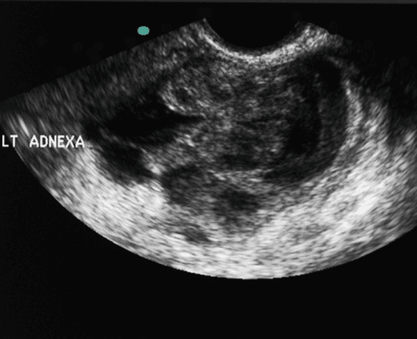 **Imaging Modality:** Transvaginal Ultrasound (TVUS)

**Anatomical Region:** Left adnexa, coronal plane.

**Observed Pathology:** Large, complex tubo-ovarian mass consistent with a Tubo-Ovarian Abscess (TOA).

**Characteristic Visual Features:** 
The image demonstrates a poorly defined, multi-loculated heterogeneous mass involving the left adnexal region. Key features include:
*   **Echo Texture:** A mixture of hypoechoic and solid-appearing components with internal debris, characteristic of an inflammatory or purulent collection.
*   **Architecture:** The mass shows thick, irregular walls and internal septations. There is a lack of clear demarcation between the ovary and the fallopian tube, forming a "tubo-ovarian complex."
*   **Fluid Components:** Presence of low-level internal echoes within cystic areas, suggesting complex fluid or pus.

**Key Diagnostic Features:** 
The primary diagnostic cue is the complete loss of normal adnexal architecture, replaced by a disorganized, heterogeneous mass. The "cogwheel" or "beaded" appearance often associated with salpingitis is obscured by the expansive, organized abscess formation. These sonographic findings are highly suggestive of Pelvic Inflammatory Disease (PID) progressing to a tubo-ovarian abscess.