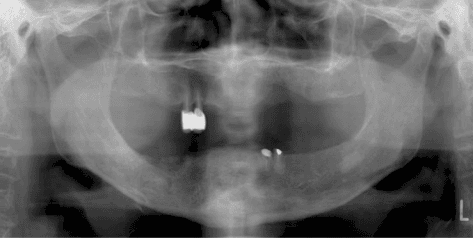 **Imaging Modality:** Panoramic radiograph (Orthopantomogram).

**Anatomical Region:** Edentulous mandible and maxilla, including the temporomandibular joints and maxillary sinuses.

**Observed Pathology:** Evidence of chronic osteomyelitis or osteonecrosis of the jaw. The right mandibular body and angle exhibit significant heterogeneous radiopacity and radiolucency.

**Characteristic Visual Features:**
*   **Sequestrum:** An island of dense, non-vital bone is visible within the right mandibular body, surrounded by a radiolucent zone of granulation tissue or involucrum formation.
*   **Bone Density:** There is a generalized decrease in bone density (osteopenia) with moth-eaten radiolucent patterns in the affected right mandibular region, indicating active bone destruction.
*   **Dental Status:** Predominantly edentulous arches with a few remaining dental remnants and radiopaque restorative materials in the upper right and lower left quadrants.
*   **Cortical Changes:** Thinning and irregularity of the inferior border of the mandible on the right side.

**Key Diagnostic Features:** The presence of a localized sequestrum associated with ill-defined osteolytic changes is highly characteristic of inflammatory or necrotic bone disease, such as Medication-Related Osteonecrosis of the Jaw (MRONJ) or actinomycotic osteomyelitis.