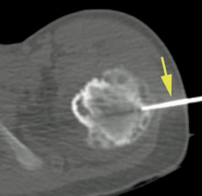 **Modality:** Axial CT-fluoroscopic image.

**Anatomic Region:** Subtrochanteric region of the proximal femur.

**Pathology/Observation:** The image demonstrates significant osteoproliferative changes characterized by marked periosteal and endosteal new bone formation. The cortical thickening appears robust with smooth outer contours. Internally, multiple intraosseous lytic areas are visible within the thickened bone, suggesting a chronic inflammatory or infectious process, such as chronic osteomyelitis.

**Interventional Features:** A radiopaque biopsy needle (indicated by a yellow arrow) is visualized traversing the lateral soft tissues and the thickened cortex to access the medullary compartment for tissue sampling.

**Key Diagnostic Features:**
*   **Bone Reaction:** Dense, smooth periosteal reaction and endosteal scalloping.
*   **Lucencies:** Multi-focal lytic lesions within the hyperostotic bone.
*   **Clinical Procedure:** CT-guided percutaneous bone biopsy.

**Clinical Context:** These imaging features—specifically the combination of smooth cortical thickening and lytic foci—are characteristic of chronic osteomyelitis or certain benign bone-forming lesions. The image documents the procedural targeting of the lesion for histopathological correlation.