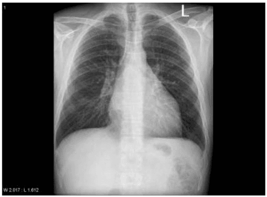 **Modality:** Frontal projection (PA/AP) chest radiograph (CXR).

**Anatomical Region:** Thorax, focusing on the mediastinum and tracheobronchial tree.

**Key Findings:**
- **Tracheobronchial Tree:** Significant widening of the subcarinal angle (splaying of the carina), characterized by the elevation of the left mainstem bronchus.
- **Cardiomediastinal Silhouette:** Global cardiomegaly is present. There is specific evidence of left atrial enlargement, indicated by the "double density" sign (overlapping of the enlarged left atrium and the right atrium) and the aforementioned carinal splaying. 
- **Lungs:** Lung fields appear relatively clear without overt focal consolidation or pleural effusion, though there is prominence of the hila.
- **Skeleton/Soft Tissues:** Visualized bony structures and soft tissues are within normal limits for this projection.

**Diagnostic Significance:**
The splaying of the carina (subcarinal angle >90 degrees) in the context of a double density sign is a classic radiologic indicator of left atrial enlargement. This can be associated with conditions such as mitral valve disease or chronic heart failure. 

**Database Keywords:** Chest X-ray, cardiomegaly, splayed carina, subcarinal angle, left atrial enlargement, double density sign, mitral valve disease.