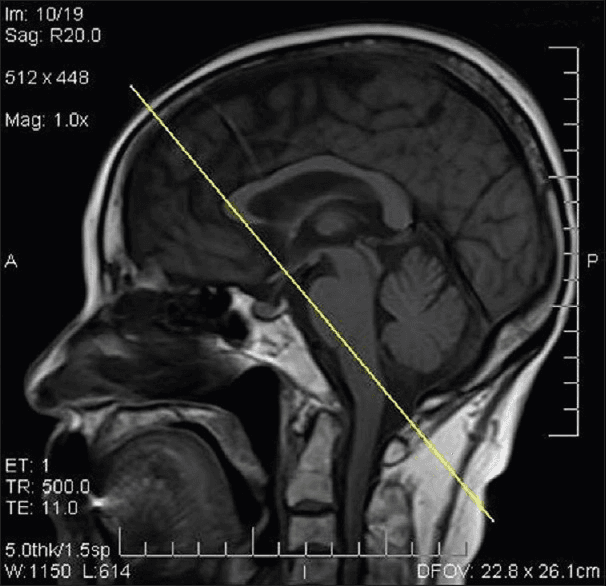 **Modality:** T1-weighted Magnetic Resonance Imaging (MRI).

**Anatomical Region:** Sagittal view of the head and upper cervical spine.

**Key Landmarks:** Visible structures include the cerebral cortex, corpus callosum, brainstem (midbrain, pons, medulla), cerebellum, and the upper cervical vertebrae. The cisterna magna (cerebellomedullary cistern) is clearly delineated posterior to the medulla and inferior to the cerebellum.

**Procedural Context:** The image features a diagnostic overlay consisting of a straight yellow line. This line illustrates the trajectory for a suboccipital or cisternal puncture. 

**Characteristic Visual Features:**
*   **Trajectory:** The line originates from the posterior-superior aspect of the skull, passing through the brain parenchyma, and terminates in the region of the cisterna magna.
*   **Cisterna Magna:** Visible as a pocket of cerebrospinal fluid (CSF) located between the posterior surface of the medulla and the inferior surface of the cerebellum, superior to the foramen magnum.
*   **Technical Parameters:** Image annotations indicate a TR of 500.0 ms, TE of 11.0 ms, and a slice thickness of 5.0 mm.

**Diagnostic Use:** This image serves as a reference for planning or demonstrating a cisternal puncture, an alternative method for CSF access when lumbar puncture is contraindicated or unsuccessful.