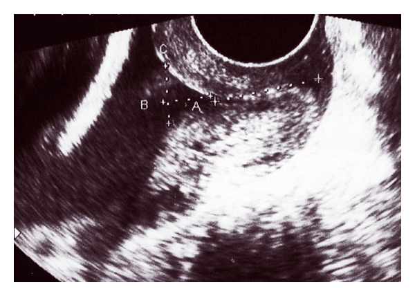 **Imaging Modality:** Transvaginal Ultrasound (TVUS) in a sagittal plane.

**Anatomical Region:** Female pelvis, specifically the uterine cervix during pregnancy.

**Observed Pathology:** Cervical insufficiency characterized by prominent "funneling" of the internal cervical os.

**Characteristic Visual Features:**
*   **Funneling:** There is a clear V-shaped or U-shaped protrusion of the amniotic sac into the endocervical canal.
*   **Measurements:** Electronic calipers are used to quantify the biometric parameters of the cervix. Marker **A** indicates the residual functional cervical length (closed portion), while marker **B** denotes the width of the funnel at the internal os. Marker **C** outlines the depth of the funneling.
*   **Cervical Effacement:** The image demonstrates significant shortening of the functional cervical length due to the opening of the internal os, while the external os remains closed.
*   **Amniotic Sac:** Anechoic fluid (amniotic fluid) is visible filling the dilated portion of the upper cervical canal.

**Diagnostic Significance:** These findings are characteristic of cervical ripening or incompetence, serving as a critical sonographic marker for assessing the risk of preterm labor or second-trimester pregnancy loss.