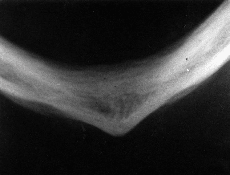**Imaging Modality:** Intraoral occlusal radiograph (X-ray).

**Anatomical Region:** Anterior mandible and symphysis menti, viewed from a submental-vertex/occlusal perspective.

**Observed Pathology:** The image demonstrates a characteristic "onion-skin" appearance, indicating periosteal reaction. There is evidence of proliferative periostitis (Garre's osteomyelitis) characterized by multiple radiopaque laminations of new bone formed parallel to the cortical surface.

**Characteristic Visual Features:**
*   **Periosteal New Bone Formation:** Distinct, concentric layers of radiopaque bone resembling onion layers.
*   **Cortical Expansion:** Bilateral expansion of the mandibular cortex, most prominent at the symphysis.
*   **Bone Density:** Mixed radiolucent and radiopaque appearance within the expanded cortical layers.
*   **Symmetry:** The periosteal thickening appears relatively symmetrical across the midline of the mandibular arch.

**Diagnostic Differentiating Features:** The presence of thin, parallel, circumferential laminations of bone without significant cortical destruction or sunburst spiculations is highly suggestive of Garré’s chronic nonsuppurative sclerosing osteomyelitis, distinguishing it from aggressive malignancies like osteosarcoma or Ewing sarcoma.