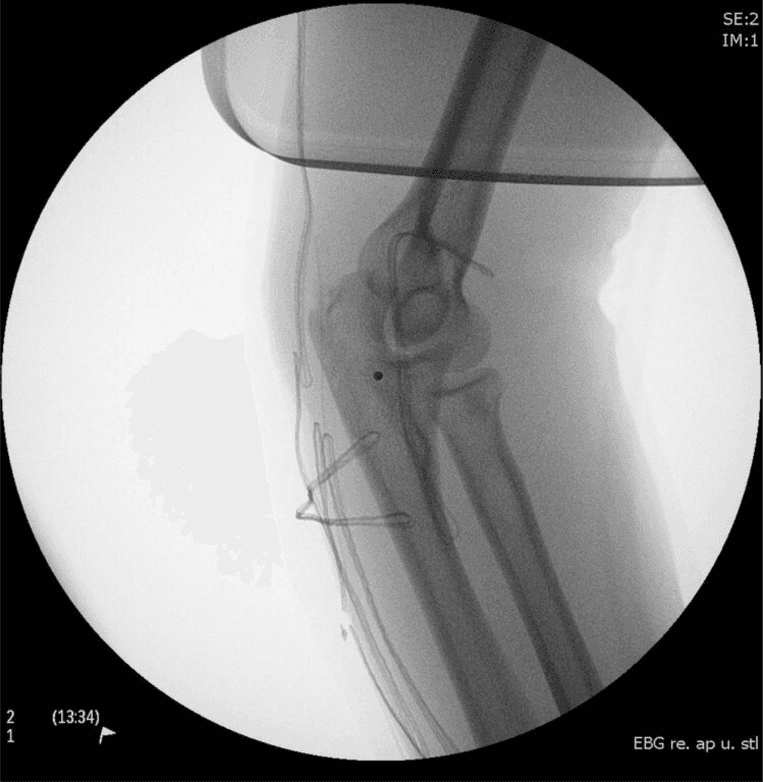 **Imaging Modality:** Intraoperative fluoroscopy (C-arm radiograph).

**Anatomical Region:** Lateral view of the right elbow joint, including the distal humerus, proximal radius, and proximal ulna (olecranon).

**Observed Pathology/Procedure:** Post-surgical repair of a triceps tendon rupture. The image demonstrates the implementation of a transosseous suture technique for tendon refixation to the olecranon process.

**Characteristic Visual Features:**
*   **Hardware:** Multiple radiopaque, high-tensile sutures or wires are visible traversing the proximal ulna. 
*   **Configuration:** The sutures follow a transosseous drill hole pattern, looping through the dorsal aspect of the olecranon to secure the distal triceps brachii tendon.
*   **Joint Alignment:** The ulnohumeral and radiocapitellar joints appear grossly aligned in a partially flexed position. 
*   **Soft Tissue:** Subtle thickening of the posterior soft tissues is noted, consistent with the surgical site and tendon distal stump localization.

**Key Diagnostic Features:** Identification of transosseous tunnels and suture material at the anatomical insertion point of the triceps tendon on the olecranon, confirming surgical stabilization of a previously ruptured extensor mechanism.