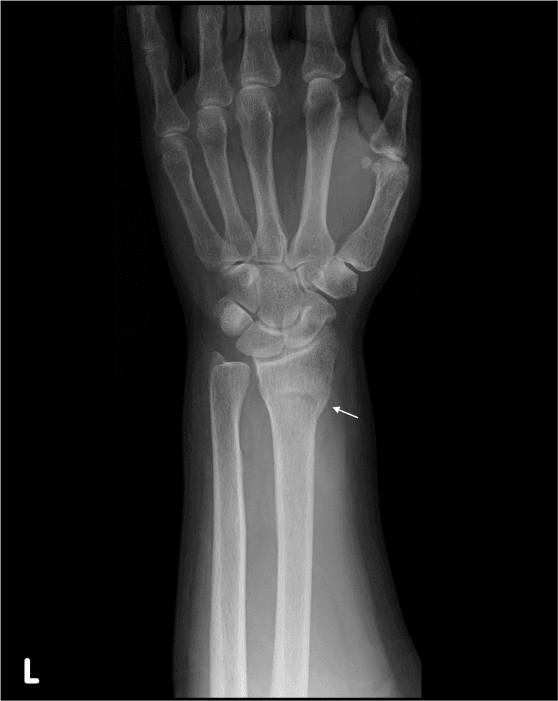 **Imaging Modality:** Posterior-anterior (PA) radiograph (X-ray).

**Anatomical Region:** Left wrist and distal forearm, including the distal radius, distal ulna, carpal bones, and proximal metacarpals.

**Observed Pathology:** Buckle (torus) fracture of the distal radial metaphysis.

**Characteristic Visual Features:**
*   **Fracture Morphology:** There is a discrete cortical bulging or "buckling" of the lateral cortex of the distal radius, indicated by a white arrow. 
*   **Alignment:** The fracture is incomplete, non-displaced, and demonstrates no significant angulation or shortening of the radial shaft.
*   **Joint Integrity:** The radiocarpal and distal radioulnar joints (DRUJ) appear maintained with preserved joint spaces. No evidence of carpal bone fracture or dislocation is visualized.
*   **Secondary Findings:** The distal ulnar epiphysis and shaft remain intact. Surrounding soft tissues appear within normal limits for this projection.

**Key Diagnostic Features:** The localized cortical protrusion without a distinct fracture line through the entire bone thickness is characteristic of a torus-type injury, typically seen in pediatric or adolescent populations with incomplete ossification.