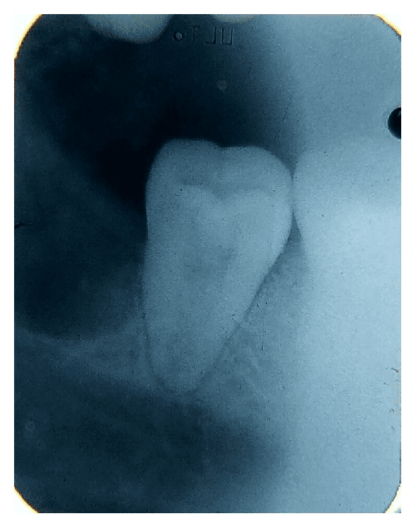 **Imaging Modality:** Intraoral periapical (retroalveolar) radiograph.

**Anatomical Region:** Posterior mandible/maxilla, featuring a molar and adjacent edentulous space.

**Observed Findings:**
The radiograph displays a post-extraction tooth socket distal to a fully erupted molar. The extraction site (likely the third molar or "wisdom tooth" region) appears as a well-defined radiolucent area within the alveolar bone, corresponding to the anatomical space previously occupied by the tooth roots. The lamina dura of the socket is partially visible, indicating a recent postoperative state.

**Characteristic Visual Features:**
- **Primary Feature:** A distinct radiolucent void (extraction socket) with a shape mimicking the root morphology.
- **Adjacent Structures:** The neighboring molar remains in situ, showing clear enamel-dentin boundaries and pulp chamber morphology.
- **Bone Quality:** Surrounding trabecular bone density appears within normal limits for a postoperative site, with no immediate evidence of retained root fragments or gross pathological lesions.
- **Landmarks:** The alveolar crest is visible, showing the surgical site’s relationship to the gingival margin.

**Clinical Context:** Standard postoperative imaging to verify complete tooth removal and assess the integrity of the surrounding alveolar bone and adjacent dentition.