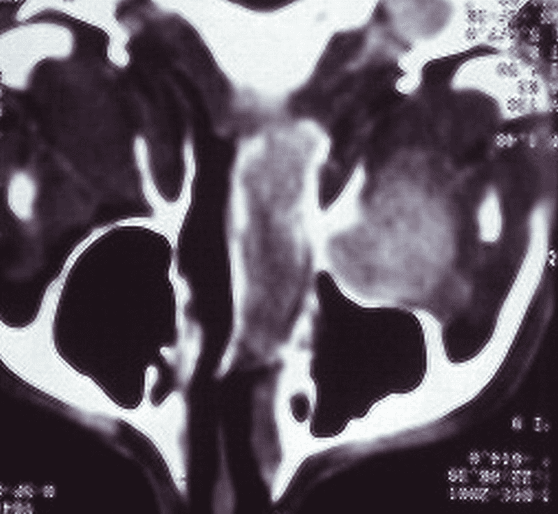 **Imaging Modality:** Axial computed tomography (CT) scan of the midface and paranasal sinuses.

**Anatomical Region:** Maxillofacial region, specifically the right retromaxillary space, pterygopalatine fossa, and nasal cavity.

**Observed Pathology:** An expansive, soft-tissue density mass is localized to the right retromaxillary and infratemporal regions. The lesion demonstrates significant mass effect, resulting in the characteristic anterior bowing of the posterior wall of the right maxillary sinus (Holman-Miller sign). There is total obliteration and opacification of the right nasal cavity with a marked leftward deviation of the nasal septum.

**Characteristic Visual Features:**
*   **Bone Remodeling:** Smooth, pressure-induced anterior displacement of the posterior maxillary cortex rather than aggressive destruction.
*   **Expansion:** The mass extends medially through the sphenopalatine foramen area into the nasopharynx and nasal fossa.
*   **Density:** Heterogeneous soft-tissue attenuation.

**Key Diagnostic Features:** The combination of a retromaxillary mass with the Holman-Miller sign and nasal cavity extension is highly characteristic of a juvenile nasopharyngeal angiofibroma (JNA) or similar slow-growing, benign but locally aggressive neoplasm.