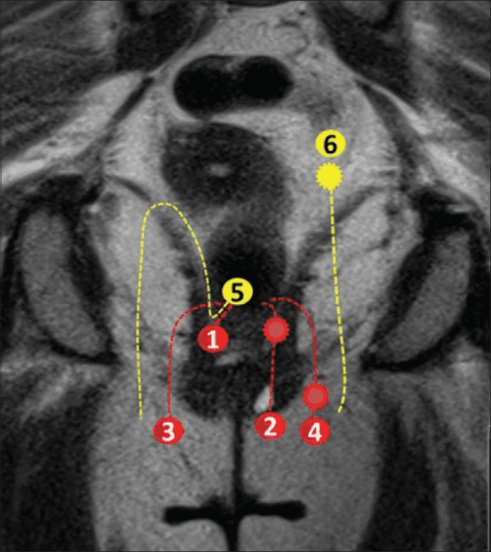 **Imaging Modality:** Coronal T2-weighted Magnetic Resonance Imaging (MRI) of the pelvis with superimposed schematic diagrams.

**Anatomical Region:** The perianal and pelvic floor region, specifically showing the anal canal, internal and external anal sphincters, ischioanal/ischiorectal fossae, and the levator ani muscle complex.

**Content Description:** This image provides a comparative schematic of perianal fistulous tracts according to the St. James’s University Hospital MRI classification. Numbered annotations (1–6) and color-coded dashed lines delineate different grades of fistula complexity:
*   **Grade 1 & 2 (Intersphincteric):** Red dashed lines confined between the internal and external sphincters, including simple tracks and those with associated abscesses.
*   **Grade 3 & 4 (Transsphincteric):** Lines extending through the external sphincter into the ischioanal fossa, with Grade 4 illustrating secondary tracks or abscesses.
*   **Grade 5 (Supralevator):** Yellow dashed line extending superior to the levator ani muscle.
*   **Grade 6 (Extrasphincteric):** Yellow dashed line illustrating a track originating from the pelvic cavity/rectum, bypassing the sphincter complex entirely.

**Clinical Significance:** This educational schematic serves as a reference for grading fistula-in-ano, identifying relationship to the sphincter mechanism, and detecting secondary complications like abscess formation or supralevator extension.