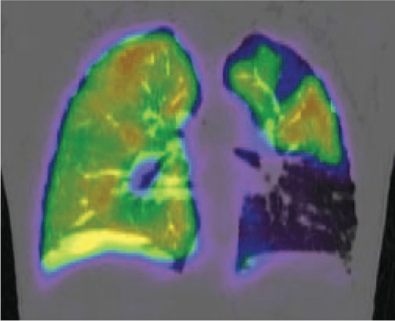**Imaging Modality:** Ventilation-Perfusion (V/Q) Lung Scintigraphy / SPECT-CT Fusion image.

**Anatomical Region:** Bilateral thoracic cavity and lungs.

**Observed Pathology:** The image demonstrates a significant ventilation-perfusion mismatch localized to the left lung. While the right lung shows relatively homogeneous and preserved tracer distribution, the left lung exhibits a large, segmental, wedge-shaped area of absent or severely diminished perfusion in the lower lobe and mid-lung zones.

**Characteristic Visual Features:** 
- **Right Lung:** Normal tracer uptake appearing as green-to-yellow pseudo-coloring, indicating balanced ventilation and perfusion.
- **Left Lung:** A distinct "cold zone" or photopenic area is visible in the lower two-thirds of the lung field, represented by a dark/purple-black void against the functional tracer. This indicates a profound perfusion deficit.
- **Distribution:** The deficit is peripheral and follows a segmental distribution, characteristic of vascular occlusion.

**Key Diagnostic Features:** The presence of a V/Q mismatch—characterized by preserved lung volume/structure but focal absence of blood flow—is a primary scintigraphic hallmark of pulmonary embolism or significant pulmonary arterial obstruction. The image highlights the functional disparity between the two hemithoraces.