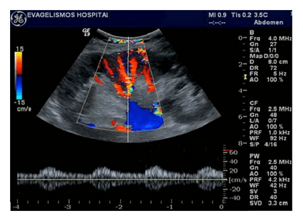 **Imaging Modality:** Spectral Doppler and Color Doppler Ultrasound.

**Anatomical Region:** Intrarenal arterial vasculature within the renal parenchyma.

**Observed Pathology:** Abnormal arterial hemodynamics consistent with a "tardus parvus" waveform, typically diagnostic of significant proximal renal artery stenosis (RAS).

**Characteristic Visual Features:**
*   **Spectral Doppler:** The waveform demonstrates a delayed systolic upstroke (prolonged acceleration time) and a reduced, rounded systolic peak (low peak systolic velocity). There is a loss of the early systolic notch.
*   **Color Doppler:** The upper panel shows color flow within the renal vasculature, mapping the sampling gate for the pulse wave (PW) Doppler acquisition.
*   **Quantitative Indices:** Visible scale indicating low velocity and dampened pulsatility compared to normal intrarenal arterial standards.

**Key Diagnostic Features:** The "tardus" (slow/late) and "parvus" (small/weak) morphology serves as an indirect sign of high-grade upstream obstruction. This pattern is characterized by an acceleration time (AT) typically exceeding 0.07 seconds and a diminished resistive index (RI), reflecting dampened pressure distal to a stenotic segment.