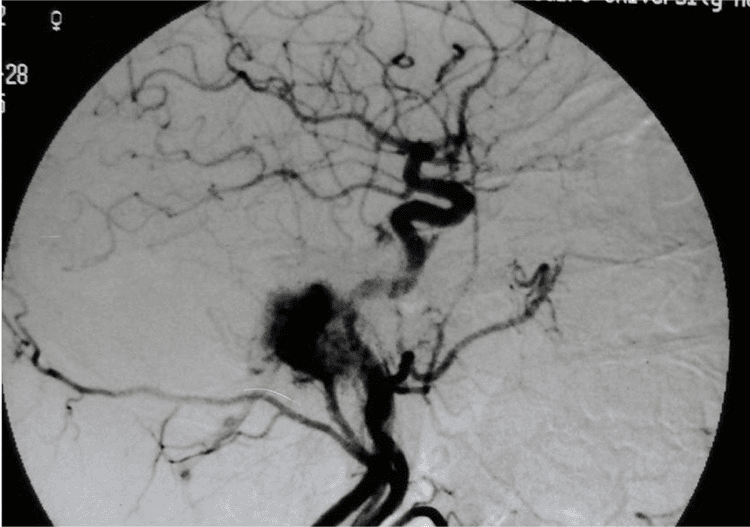 **Imaging Modality:** Digital Subtraction Angiography (DSA), lateral projection.

**Anatomical Region:** Skull base and cervical carotid artery distribution.

**Observed Pathology:** Glomus jugulare tumor (paraganglioma). The image demonstrates a highly vascularized, lobulated mass located at the level of the jugular bulb.

**Characteristic Visual Features:** 
- **Tumor Blush:** A dense, intense, and persistent capillary opacification (blush) is evident during the arterial phase, characteristic of hypervascular skull base tumors.
- **Arterial Supply:** Multiple hypertrophied feeding arteries are visible branching from the external carotid artery system toward the lesion.
- **Mass Effect:** The lesion is situated in the posteroinferior aspect of the petrous temporal bone, adjacent to the carotid bifurcations and the internal carotid artery (ICA) siphon.
- **Vascular Architecture:** Disorganized neovascularization within the tumor matrix, appearing as a "sunburst" or mottled enhancement pattern.

**Key Diagnostic Features:** The location at the jugular foramen combined with the rapid, intense vascular blush on angiography is pathognomonic for a glomus jugulare tumor, differentiating it from less vascularized schwannomas or meningiomas in the same region.