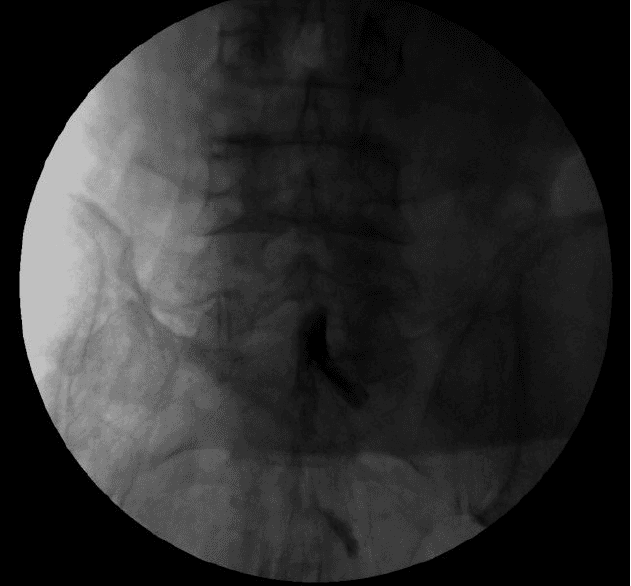 **Imaging Modality:** Fluoroscopy (Anteroposterior view)

**Anatomical Region:** Lumbar spine and sacrum (L4-S1 region).

**Procedure/Observation:** This image captures a fluoroscopically guided spinal injection, likely an epidural or subarachnoid administration. A radiopaque contrast medium (injectate) is visible as a focal, hyperdense (dark in this inverted-style display) accumulation near the midline at the lumbosacral junction.

**Characteristic Visual Features:**
- **Distribution:** The contrast agent exhibits a gravity-dependent settling pattern. Rather than a linear spread along nerve roots or symmetric cephalocaudal flow, the injectate pools preferentially toward the dependent side of the spinal canal.
- **Positioning:** The anatomical orientation and flow pattern are consistent with the patient being in a lateral decubitus position during the procedure.
- **Landmarks:** Lumbar vertebral bodies, intervertebral spaces, and the sacral promontory are visible, providing spatial orientation for the needle placement and subsequent spread of medication.

**Clinical Significance:** This image demonstrates the baricity and gravitational influence on the distribution of injectate within the spinal compartments, a critical factor in determining the dermatomal level and lateralization of anesthetic or corticosteroid effect.