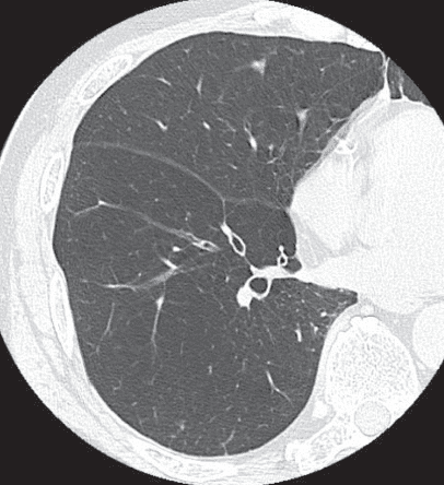 **Imaging Modality:** High-resolution computed tomography (HRCT) of the chest.

**Anatomical Region:** Axial section of the right lung at the level of the pulmonary hilum.

**Observed Pathology:** Panacinar (panlobular) emphysema.

**Characteristic Visual Features:** The image demonstrates diffuse, uniform low attenuation of the lung parenchyma. There is a notable absence of discrete, focal low-attenuation areas (LAA) or visible cyst walls, which differentiates this from centriacinar or paraseptal subtypes. The pulmonary vasculature appears attenuated and sparse, appearing as thin, simplified branching structures within the hyperlucent lung field. The interlobular septa and bronchovascular bundles remain visible but are set against a background of generalized parenchymal destruction.

**Key Diagnostic Features:** Global involvement of the secondary pulmonary lobule rather than focal destruction. This pattern of widespread lung simplification and uniform decrease in attenuation is characteristic of panacinar emphysema, often associated with alpha-1 antitrypsin deficiency. No significant pleural effusion or consolidations are present in the visualized field.
