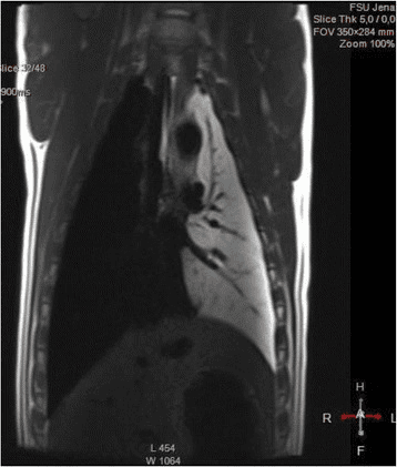 **Imaging Modality:** In-vivo Magnetic Resonance Imaging (MRI), T2-weighted sequence (TE: 84 ms / TR: 900 ms).

**Anatomical Region:** Coronal section of the porcine thoracic cavity, including the lungs, mediastinum, and diaphragm.

**Observed Findings:**
*   **Right Lung (image left):** Exhibits normal ventilation characterized by uniform signal void (hypointensity), typical of air-filled pulmonary parenchyma on standard MRI sequences.
*   **Left Lung (image right):** Demonstrates diffuse, high T2 signal intensity (hyperintensity) consistent with total lung flooding or massive alveolar edema. The fluid-filled parenchyma provides high contrast against the mediastinal structures.
*   **Key Landmarks:** Clear visualization of the diaphragmatic contour, spinal column, and central thoracic vasculature. Branching pulmonary structures are visible within the hyperintense flooded lung, likely representing air bronchograms or vascular displacement.

**Clinical/Diagnostic Context:** This image serves as a comparative model for pulmonary edema or alveolar flooding, illustrating the significant contrast in T2 signal between aerated and fluid-saturated lung tissue. The unilateral distribution highlights the experimental or localized nature of the pathology.