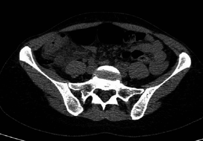 **Modality:** Computed Tomography (CT), axial section.

**Anatomical Region:** Abdomino-pelvic region at the level of the iliac crests and sacrum.

**Key Findings:** The image demonstrates a thickened, dilated vermiform appendix located in a retrocecal position. There is clear evidence of periappendiceal fat stranding (increased attenuation/infiltration of the surrounding mesenteric fat), indicating a localized inflammatory process. The cecum is visible anterior to the inflamed appendix. No gross evidence of abscess formation or free intraperitoneal air is noted in this specific slice.

**Pathology:** Acute retrocecal appendicitis.

**Diagnostic Features:** 
- **Increased appendiceal diameter:** Tubular structure showing wall thickening.
- **Fat stranding:** Hallmark secondary sign of acute inflammation in the right lower quadrant.
- **Anatomic variant:** Retrocecal orientation of the appendix.

**Clinical Significance:** These radiologic features are diagnostic of acute appendicitis, used to guide surgical intervention or conservative management. The retrocecal position is a critical surgical landmark for operative planning.
