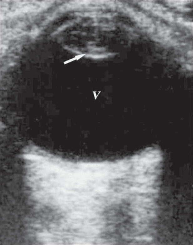 **Imaging Modality:** Ophthalmic B-scan ultrasonography (USG).

**Anatomical Region:** Axial view of the globe (eye).

**Observed Pathology:** Mature cataract.

**Characteristic Visual Features:** 
The image displays a cross-sectional view of the eye. Within the anterior segment, the crystalline lens appears abnormally prominent. Key sonographic findings include:
*   **Intralenticular Echoes:** Presence of internal, high-amplitude reflective material within the lens substance, indicating a loss of normal transparency and cortical opacification.
*   **Posterior Capsule Enhancement:** A distinct, curvilinear hyperechoic signal at the posterior boundary of the lens (marked by a white arrow), representing a marked posterior capsular echo.
*   **Vitreous Chamber:** The vitreous cavity (labeled "V") appears primarily anechoic (black), suggesting the absence of significant hemorrhage or retinal detachment in this plane.

**Key Diagnostic Features:** The combination of increased internal lenticular echogenicity and a highly reflective posterior capsule in a patient with clinical vision loss is diagnostic of a cataract. This modality is particularly useful for evaluating the posterior segment when the ocular media is too opaque for direct ophthalmoscopy.