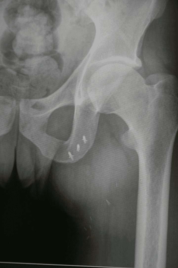 **Imaging Modality:** Anteroposterior (AP) projection radiograph (X-ray).

**Anatomical Region:** Left hip and pelvis, including the proximal femur, acetabulum, and pubic rami.

**Observed Pathology/Postoperative Status:** Postoperative imaging demonstrating the surgical repair of a proximal hamstring avulsion. The hip joint appears congruous with no acute fractures or dislocations of the femoral head or neck.

**Characteristic Visual Features:**
- **Suture Anchors:** Three radiopaque metallic suture anchors are visualized embedded within the inferior pubic ramus/ischial tuberosity region. 
- **Hardware Distribution:** The anchors are arranged in a linear pattern along the anatomical origin of the hamstring muscle group.
- **Soft Tissue:** Several small, faint radiopaque markers or surgical clips are visible in the proximal soft tissues of the medial thigh, consistent with suture reinforcement or local hemostasis.

**Key Diagnostic Features:** The presence of specific orthopedic hardware at the ischial tuberosity confirms a surgical reattachment procedure (suture anchor fixation) for a high-grade proximal hamstring tendon tear or avulsion. No secondary degenerative changes or heterotopic ossification are noted in the immediate field of view.