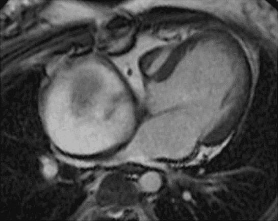 **Imaging Modality:** Cardiac Magnetic Resonance Imaging (MRI), axial steady-state free precession (SSFP) sequence.

**Anatomical Region and Landmarks:** Mediastinum and thoracic cavity showing the heart and great vessels in a patient with tricuspid atresia and prior atriopulmonary Fontan palliation.

**Observed Pathology:** Severe, aneurysmal dilatation of the right atrium (measuring approximately 7 x 7.5 cm). The massive enlargement of the right atrium causes significant mass effect and posterior displacement of adjacent structures.

**Characteristic Visual Features:** 
- **Atrial Morphometry:** Markedly enlarged, globular right atrium dominant within the thoracic cross-section.
- **Vascular Impingement:** The dilated right atrium exerts direct extrinsic compression on the pulmonary venous return pathways.
- **Ventricular Morphology:** Single functional ventricle consistent with the surgical history of tricuspid atresia.
- **Signal Characteristics:** Blood pool demonstrates typical hyperintense signal on SSFP, highlighting the disproportionate size of the atrial chamber relative to the ventricular mass and the restricted space for pulmonary veins.

**Diagnostic Context:** This appearance is characteristic of late complications following an atriopulmonary Fontan connection, where chronic pressure and volume overload lead to progressive giant atrial enlargement and secondary obstructive effects on systemic or pulmonary venous return.