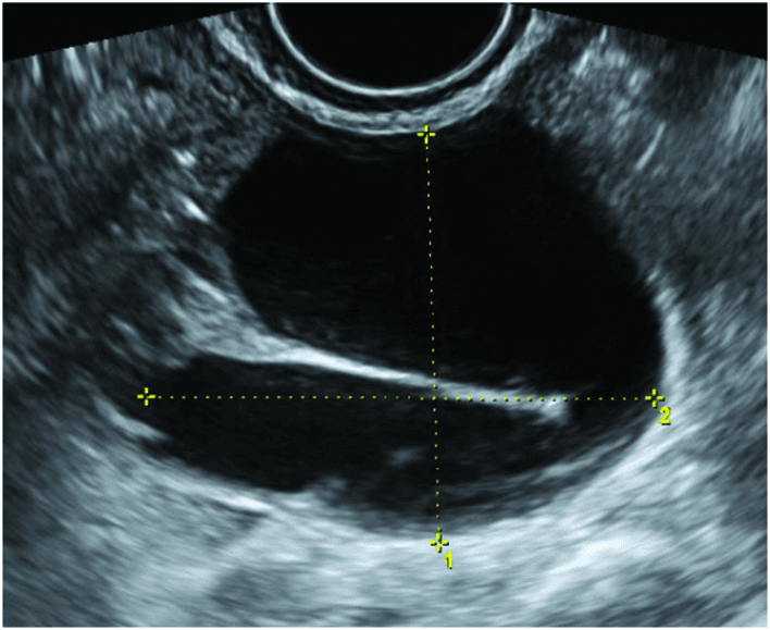 **Modality:** Transvaginal Ultrasound (TVUS), B-mode.

**Anatomic Region:** Adnexa / Fallopian tube.

**Description:** The image displays a cross-sectional view of a hydrosalpinx, appearing as an elongated, fusiform, and well-circumscribed cystic structure with anechoic internal fluid. A prominent, hyperechoic thin linear band is visible extending into the lumen, representing an incomplete septum or "cogwheel" sign. This feature is a classic sonographic hallmark of a dilated, folded fallopian tube, distinguishing it from an ovarian cyst or para-ovarian mass. 

**Visual Features:**
- **Fluid Collection:** Anechoic, simple fluid without internal debris or vascularity.
- **Wall Structure:** Smooth, thin walls with no solid papillary projections or thickened mural nodules.
- **Septation:** A pathognomonic incomplete septum (cogwheel sign/waist sign) characteristic of chronic tubal dilatation.
- **Measurements:** Orthogonal electronic calipers (marked 1 and 2) are positioned to quantify the maximum diameter of the distended lumen.

**Diagnostic Significance:** These features are highly suggestive of hydrosalpinx, typically secondary to pelvic inflammatory disease (PID) or previous tubal pathology, aiding in the differentiation of adnexal masses.